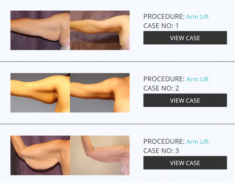 شد الذراعين